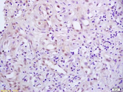 Paraformaldehyde-fixed, paraffin embedded Human gastric carcinoma; Antigen retrieval by boiling in sodium citrate buffer(pH6) for 15 minutes; Block endogenous peroxidase by 3% hydrogen peroxide for 30 minutes; Blocking buffer (normal goat serum) at 37°C for 20 minutes; Antibody incubation with PPAR Gamma(ser273) Polyclonal Antibody, Unconjugated (bs-4888R) at 1:200 overnight at 4°C, followed by a conjugated secondary antibody and DAB staining.