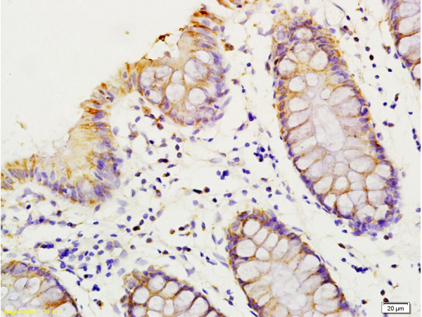 Formalin-fixed and paraffin embedded human colon carcinoma labeled with Anti-HMGA1/HMG-I/HMG-Y Polyclonal Antibody, Unconjugated (bs-1030R) at 1:200 followed by conjugation to the secondary antibody and DAB staining.