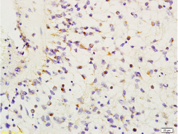 Formalin-fixed and paraffin embedded human glioma labeled with Anti-HMGA1/HMG-I/HMG-Y Polyclonal Antibody, Unconjugated (bs-1030R) at 1:200 followed by conjugation to the secondary antibody and DAB staining.