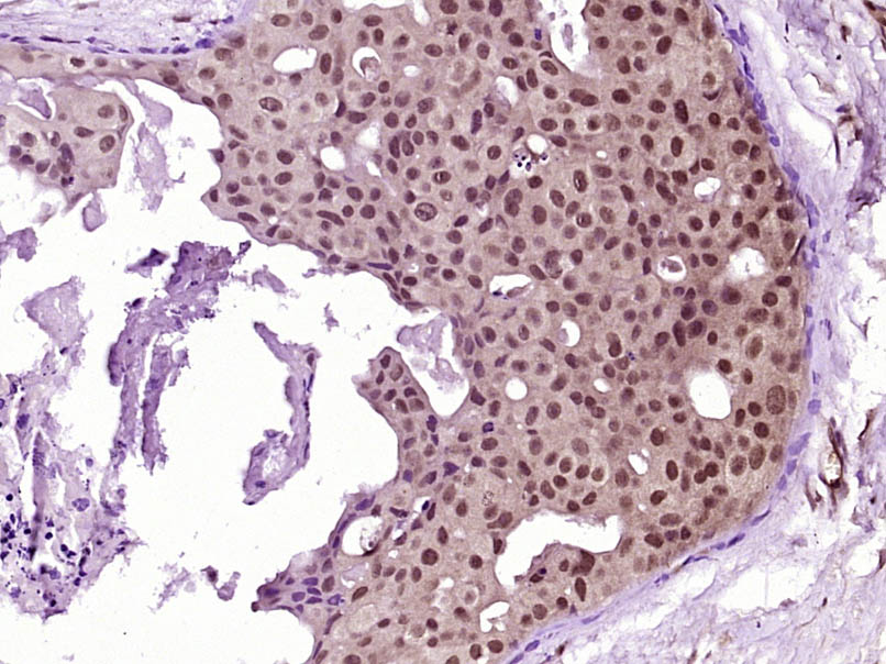 Paraformaldehyde-fixed, paraffin embedded Human breast carcinoma; Antigen retrieval by boiling in sodium citrate buffer (pH6.0) for 15min; Block endogenous peroxidase by 3% hydrogen peroxide for 20 minutes; Blocking buffer (normal goat serum) at 37°C for 30min; Antibody incubation with AKT (Ser473)(9H11) Monoclonal Antibody, Unconjugated (bsm-33281M) at 1:2000 overnight at 4°C, followed by a conjugated secondary for 20 minutes and DAB staining.