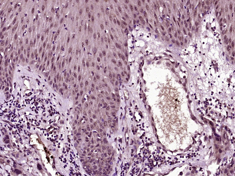 Paraformaldehyde-fixed, paraffin embedded Human skin carcinoma; Antigen retrieval by boiling in sodium citrate buffer (pH6.0) for 15min; Block endogenous peroxidase by 3% hydrogen peroxide for 20 minutes; Blocking buffer (normal goat serum) at 37°C for 30min; Antibody incubation with phospho-AKT (Ser473)(9H11) Monoclonal Antibody, Unconjugated (bsm-33281M) at 1:2000 overnight at 4°C, followed by a conjugated secondary for 20 minutes and DAB staining.