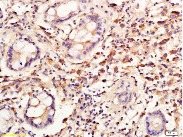 Formalin-fixed and paraffin embedded: human colon carcinoma labeled with Anti-Cyclin C Polyclonal Antibody, Unconjugated (bs-0282R) at 1:300, followed by conjugation to the secondary antibody and DAB staining