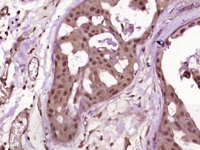 Paraformaldehyde-fixed, paraffin embedded Human Breast Carcinoma; Antigen retrieval by boiling in sodium citrate buffer (pH6.0) for 15min; Block endogenous peroxidase by 3% hydrogen peroxide for 20 minutes; Blocking buffer (normal goat serum) at 37°C for 30min; Antibody incubation with Neurogenin 3 Polyclonal Antibody, Unconjugated (bs-0922R) at 1:400 overnight at 4°C, followed by secondary and DAB staining.