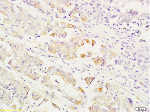 Formalin-fixed and paraffin embedded human gastric carcinoma labeled with Anti-MEK1/2(MAPKK1) Polyclonal Antibody, Unconjugated (bs-1041R) at 1:200 followed by conjugation to the secondary antibody and DAB staining.