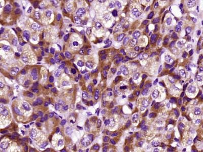 Paraformaldehyde-fixed, paraffin embedded Human liver cancer; Antigen retrieval by boiling in sodium citrate buffer (pH6.0) for 15min; Block endogenous peroxidase by 3% hydrogen peroxide for 20 minutes; Blocking buffer (normal goat serum) at 37°C for 30min; Antibody incubation with CRP (C11F2) Monoclonal Antibody, Unconjugated (bsm-0391M) at 1:400 overnight at 4°C, followed secondary and DAB staining.