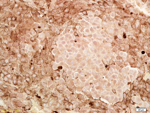 Formalin-fixed and paraffin embedded human melanoma labeled with Anti-CITED1/ABCC1 Polyclonal Antibody, Unconjugated (bs-2990R) at 1:200, followed by conjugation to the secondary antibody and DAB staining