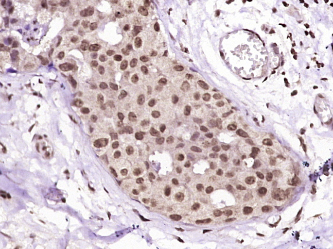 Paraformaldehyde-fixed, paraffin embedded Human breast cancer; Antigen retrieval by boiling in sodium citrate buffer (pH6.0) for 15min; Block endogenous peroxidase by 3% hydrogen peroxide for 20 minutes; Blocking buffer (normal goat serum) at 37°C for 30min; Antibody incubation with HSP27 Polyclonal Antibody, Unconjugated (bs-0730R) at 1:400 overnight at 4°C, DAB staining.