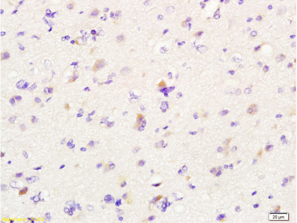 Formalin-fixed and paraffin embedded human glioma labeled with Anti-MIF Polyclonal Antibody, Unconjugated (bs-1044R) at 1:200 followed by conjugation to the secondary antibody and DAB staining.
