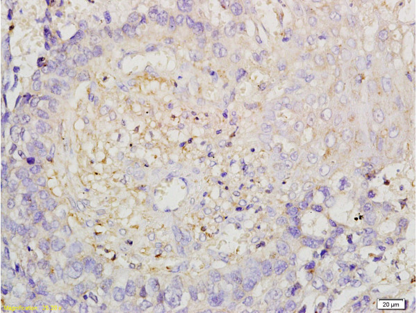 Formalin-fixed and paraffin embedded human esophageal carcinoma labeled with Anti-ROCK1 Polyclonal Antibody, Unconjugated (bs-1166R) at 1:200 followed by conjugation to the secondary antibody and DAB staining.