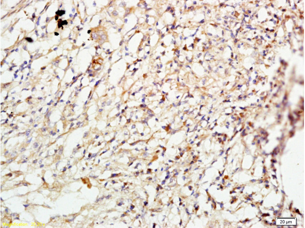 Formalin-fixed and paraffin embedded human lung carcinoma labeled with Anti-ROCK1 Polyclonal Antibody, Unconjugated (bs-1166R) at 1:200 followed by conjugation to the secondary antibody and DAB staining.