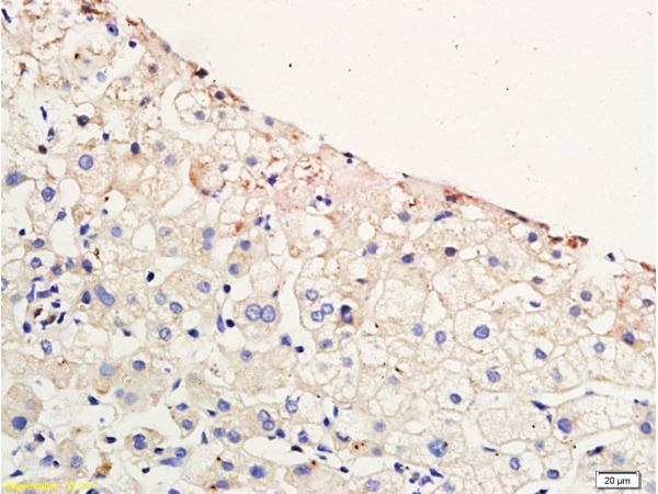 Formalin-fixed and paraffin embedded human hepatitides tissue labeled with Anti-CCR4 Polyclonal Antibody, Unconjugated (bs-1168R) at 1:200 followed by conjugation to the secondary antibody and DAB staining