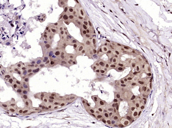 Paraformaldehyde-fixed, paraffin embedded Human breast cancer; Antigen retrieval by boiling in sodium citrate buffer (pH6.0) for 15min; Block endogenous peroxidase by 3% hydrogen peroxide for 20 minutes; Blocking buffer (normal goat serum) at 37°C for 30min; Antibody incubation with RAB35 Polyclonal Antibody, Unconjugated (bs-7765R) at 1:400 overnight at 4°C, DAB staining.