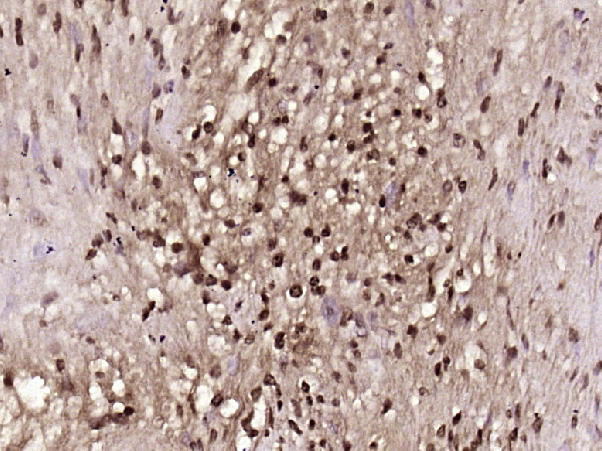 Paraformaldehyde-fixed, paraffin embedded Human Neurilemmoma Carcinoma; Antigen retrieval by boiling in sodium citrate buffer (pH6) for 15 minutes; Block endogenous peroxidase by 3% hydrogen peroxide for 30 minutes; Blocking buffer (normal goat serum) at 37°C for 20 minutes; Antibody incubation with BRCA1 Polyclonal Antibody, Unconjugated (bs-0802R) at 1:400 overnight at 4°C, followed by a conjugated secondary antibody and DAB staining.