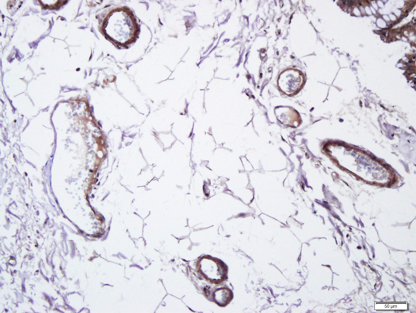 Paraformaldehyde-fixed, paraffin-embedded human colon cancer; Antigen retrieval by boiling in sodium citrate buffer (pH6.0) for 15min; Block endogenous peroxidase by 3% hydrogen peroxide for 20 minutes; Blocking buffer (normal goat serum) at 37°C for 30min; Antibody incubation with CD105 Polyclonal Antibody, Unconjugated (bs-0579R) at 1:400 overnight at 4°C, followed by a conjugated secondary for 20 minutes and DAB staining.