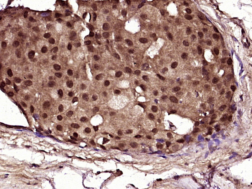 Paraformaldehyde-fixed, paraffin embedded Human Breast carcinoma; Antigen retrieval by boiling in sodium citrate buffer (pH6.0) for 15min; Block endogenous peroxidase by 3% hydrogen peroxide for 20 minutes; Blocking buffer (normal goat serum) at 37°C for 30min; Antibody incubation with NF1 Polyclonal Antibody, Unconjugated (bs-4140R) at 1:400 overnight at 4°C, followed by secondary antibody and DAB staining