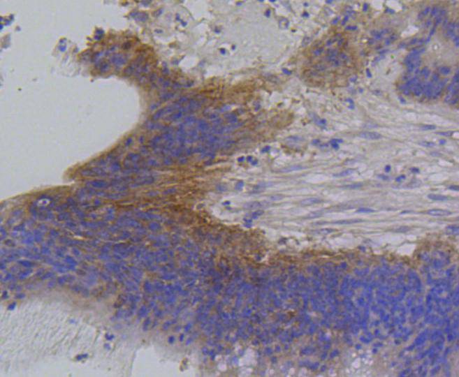 Paraformaldehyde-fixed, paraffin embedded Human Colon cancer; Antigen retrieval by boiling in sodium citrate buffer (pH6) for 15min; Block endogenous peroxidase by 3% hydrogen peroxide for 30 minutes; Blocking buffer at 37°C for 20min; Antibody incubation with IRF1 (3G7) Monoclonal Antibody (bsm-52114R) at 1:100 overnight at 4°C, followed by a conjugated secondary and DAB staining.