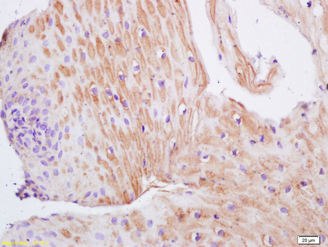 Tissue/cell: Human Gastric Carcinoma; 4% Paraformaldehyde-fixed and paraffin-embedded; Antigen retrieval: citrate buffer (0.01M, pH 6.0 ), Boiling for 15min; Block endogenous peroxidase by 3% Hydrogen peroxide for 30min; Blocking buffer (normal goat serum) at 37℃ for 20 min; Incubation: Anti-TIMP-1 Polyclonal Antibody, Unconjugated (bs-0415R) 1:200, overnight at 4°C, followed by incubation with secondary antibody and DAB staining