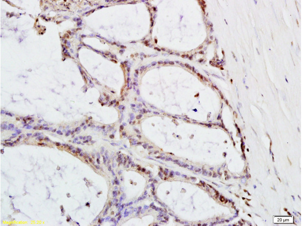 Formalin-fixed and paraffin embedded: human colon carcinoma labeled with Anti-MTLC Polyclonal Antibody (bs-0334R), Unconjugated at 1:200, followed by conjugation to the secondary antibody and DAB staining