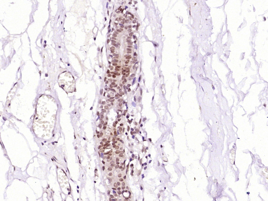 Paraformaldehyde-fixed, paraffin embedded Human breast cancer; Antigen retrieval by boiling in sodium citrate buffer (pH6.0) for 15min; Block endogenous peroxidase by 3% hydrogen peroxide for 20 minutes; Blocking buffer (normal goat serum) at 37°C for 30min; Antibody incubation with MyoD family inhibitor Polyclonal Antibody, Unconjugated (bs-18743R) at 1:400 overnight at 4°C, DAB staining.