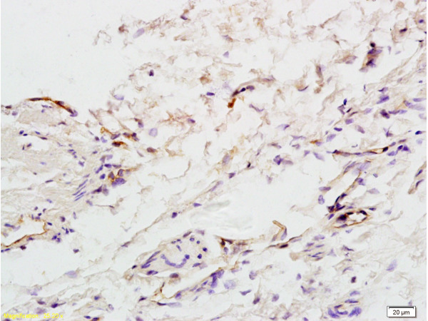 Formalin-fixed and paraffin embedded:human colon carcinoma labeled with Anti-factor VIII(FVIII)(human) Polyclonal Antibody (bs-0332R), Unconjugated at 1:200, followed by conjugation to the secondary antibody and DAB staining