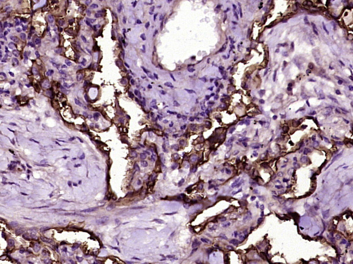 Paraformaldehyde-fixed, paraffin embedded Human lung cancer; Antigen retrieval by boiling in sodium citrate buffer (pH6.0) for 15min; Block endogenous peroxidase by 3% hydrogen peroxide for 20 minutes; Blocking buffer (normal goat serum) at 37°C for 30min; Antibody incubation with ICAM1/CD54 Monoclonal Antibody, Unconjugated (bsm-10697M) at 1:400 overnight at 4°C, DAB staining.