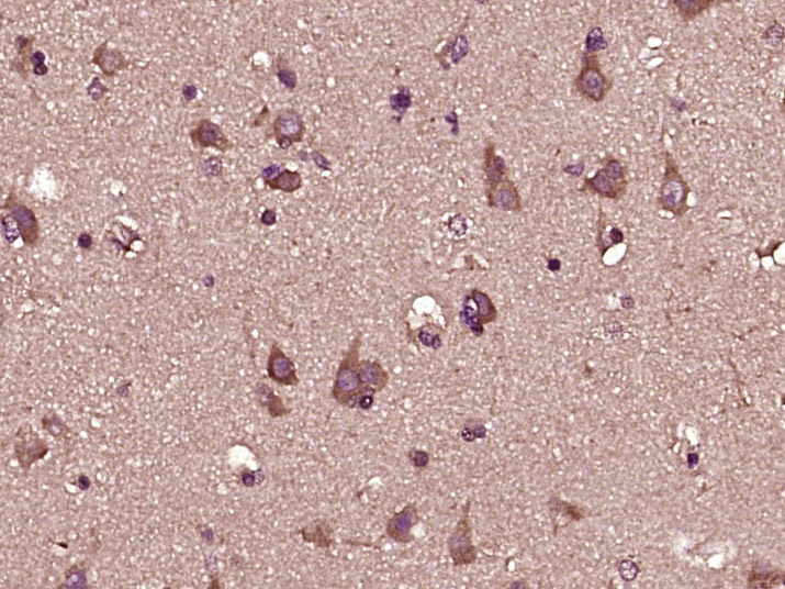 Paraformaldehyde-fixed, paraffin embedded Human Brain Glioma; Antigen retrieval by boiling in sodium citrate buffer (pH6.0) for 15min; Block endogenous peroxidase by 3% hydrogen peroxide for 20 minutes; Blocking buffer (normal goat serum) at 37°C for 30min; Antibody incubation with IFNA8 Polyclonal Antibody, Unconjugated (bs-1578R) at 1:400 overnight at 4°C, followed by secondary and DAB staining.
