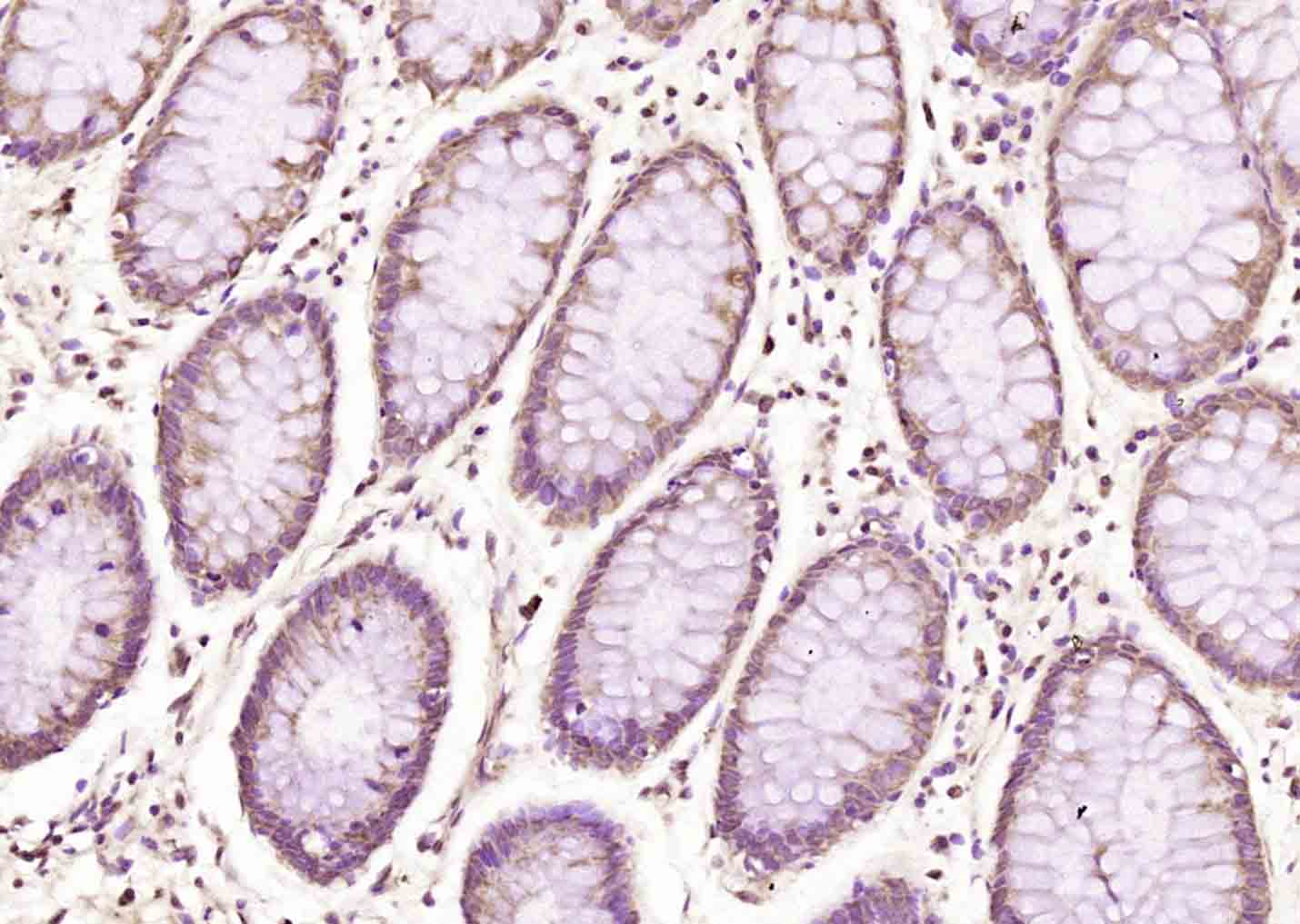 Paraformaldehyde-fixed, paraffin embedded Human Colon carcinoma; Antigen retrieval by boiling in sodium citrate buffer (pH6.0) for 15min; Block endogenous peroxidase by 3% hydrogen peroxide for 20 minutes; Blocking buffer (normal goat serum) at 37°C for 30min; Antibody incubation with ATF2 (Thr69/71) Polyclonal Antibody, Unconjugated (bs-3033R) at 1:200 overnight at 4°C, followed by secondary and DAB staining.