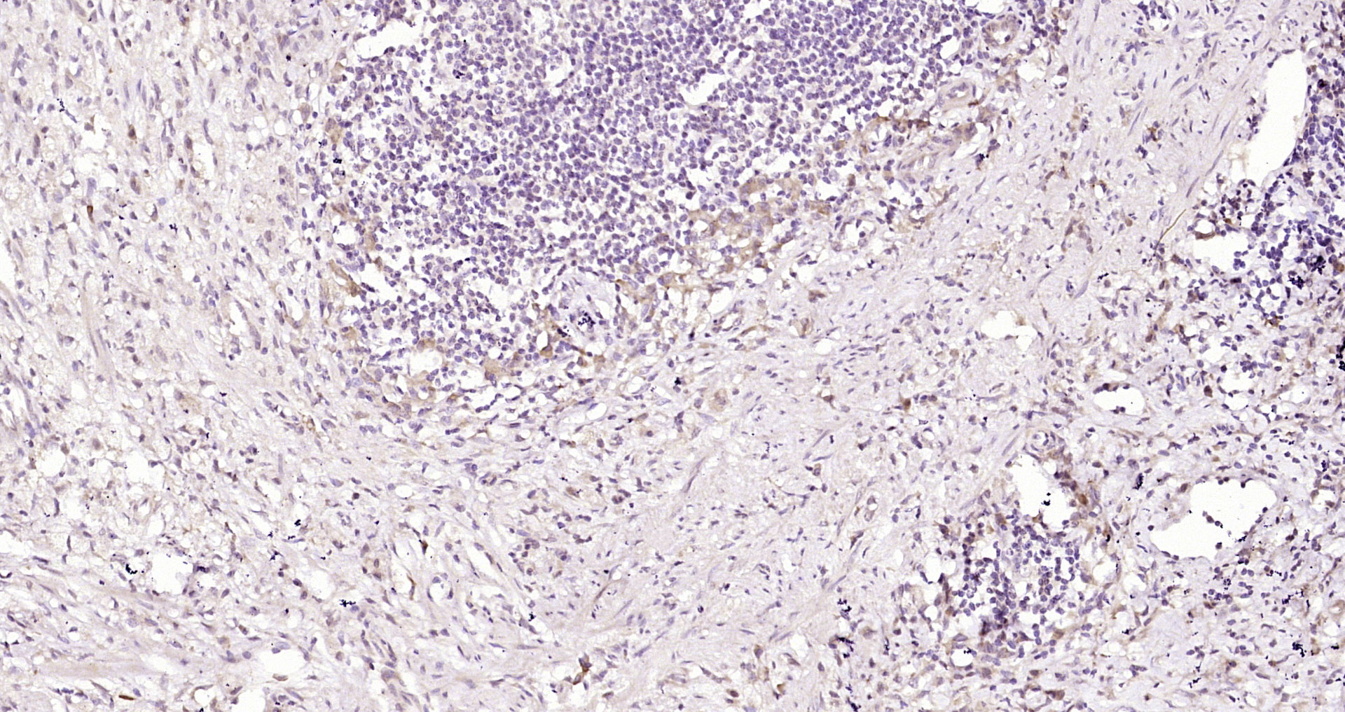 Paraformaldehyde-fixed, paraffin embedded Human stomach cancer; Antigen retrieval by boiling in sodium citrate buffer (pH6.0) for 15min; Block endogenous peroxidase by 3% hydrogen peroxide for 20 minutes; Blocking buffer (normal goat serum) at 37°C for 30min; Antibody incubation with DENND2D Polyclonal Antibody, Unconjugated (bs-9668R) at 1:200 overnight at 4°C, DAB staining.