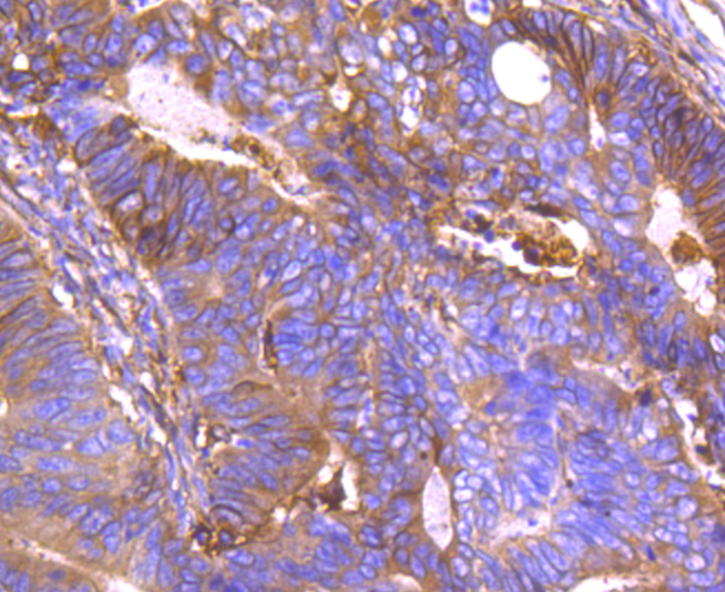 Paraformaldehyde-fixed and paraffin-embedded Human Colon Cancer tissue incubated with Annexin A2 (2F4) Monoclonal Antibody (bsm-54021R) at 1:100, overnight at 4°C, followed by a conjugated secondary antibody and DAB staining. Counterstained with hematoxylin.