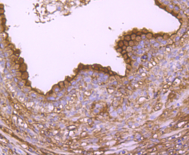 Paraformaldehyde-fixed and paraffin-embedded Human Prostate tissue incubated with Annexin A2 (2F4) Monoclonal Antibody (bsm-54021R) at 1:100, overnight at 4°C, followed by a conjugated secondary antibody and DAB staining. Counterstained with hematoxylin.