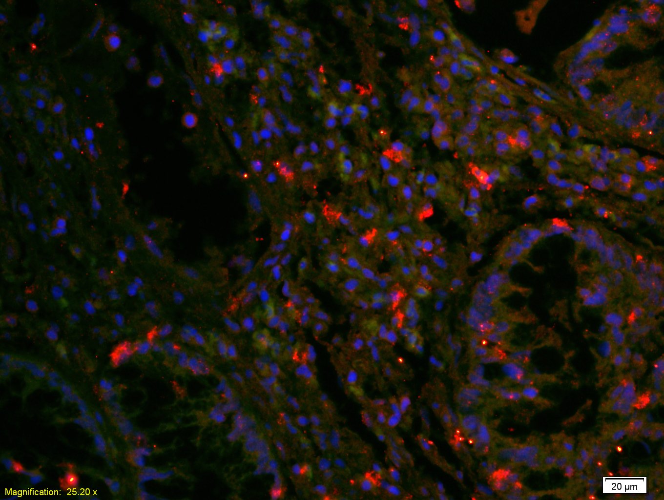 Tissue/cell: Human Rectal Carcinoma; 4% Paraformaldehyde-fixed and paraffin-embedded; Antigen retrieval: citrate buffer (0.01M, pH 6.0), Boiling bathing for 15min; Blocking buffer (normal goat serum) at 37℃ for 20 min; Incubation: EGFR Polyclonal Antibody, Unconjugated (bs-0165R) at 1:200, overnight at 4°C; The secondary antibody was Goat Anti-Rabbit IgG, Cy3 conjugated (bs-0295G-Cy3) used at 1:200 dilution for 40 minutes at 37°C. DAPI(5ug/ml, blue) was used to stain the cell nuclei.