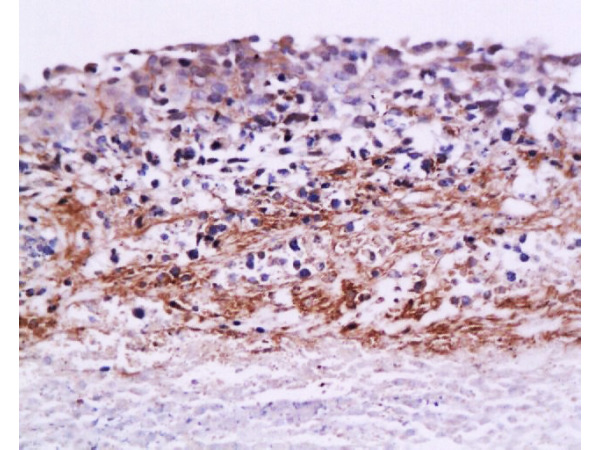 Formalin-fixed and paraffin embedded rat ovary carcinoma labeled with Anti-MMP-9 Polyclonal Antibody, Unconjugated (bs-0397R) at 1:200, followed by conjugation to the secondary antibody and DAB staining Formalin-fixed and paraffin embedded rat ovary carcinoma labeled with Anti-MMP-9 Polyclonal Antibody, Unconjugated (bs-0397R) at 1:200, followed by conjugation to the secondary antibody and DAB staining