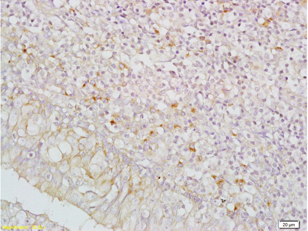 Formalin-fixed and paraffin embedded human nasopharyngeal carcinoma labeled with Anti-IGFBP5/IBP5 Polyclonal Antibody (bs-0406R), Unconjugated at 1:200, followed by conjugation to the secondary antibody and DAB staining