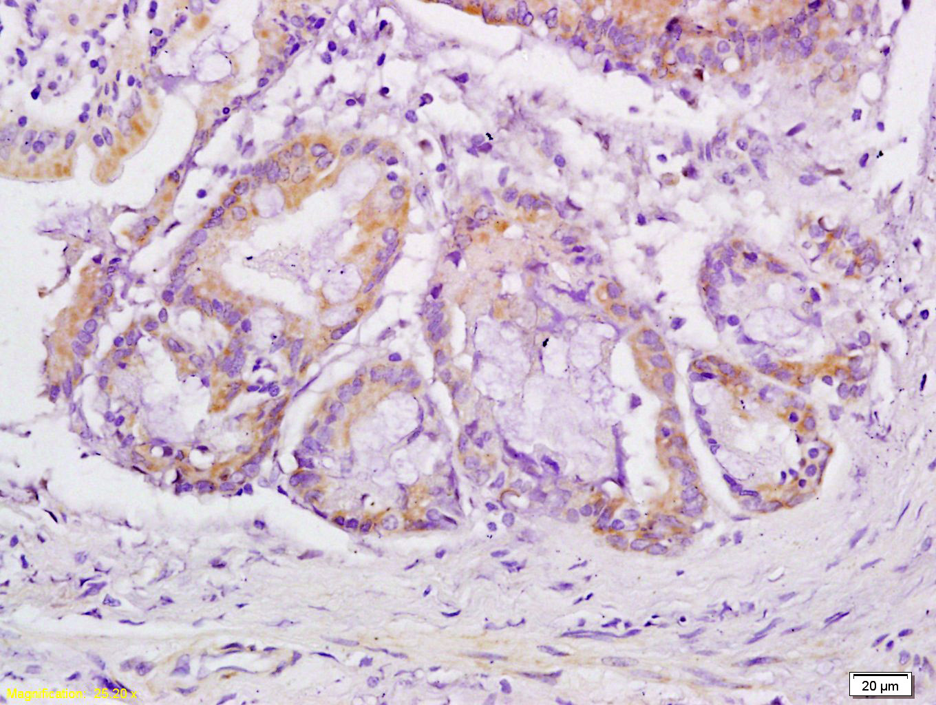 Formalin-fixed and paraffin-embedded Human Gastric Cancer labeled with VEGFR3 Polyclonal Antibody, Unconjugated (bs-2202R) at 1:200 followed by conjugation to the secondary antibody and DAB staining