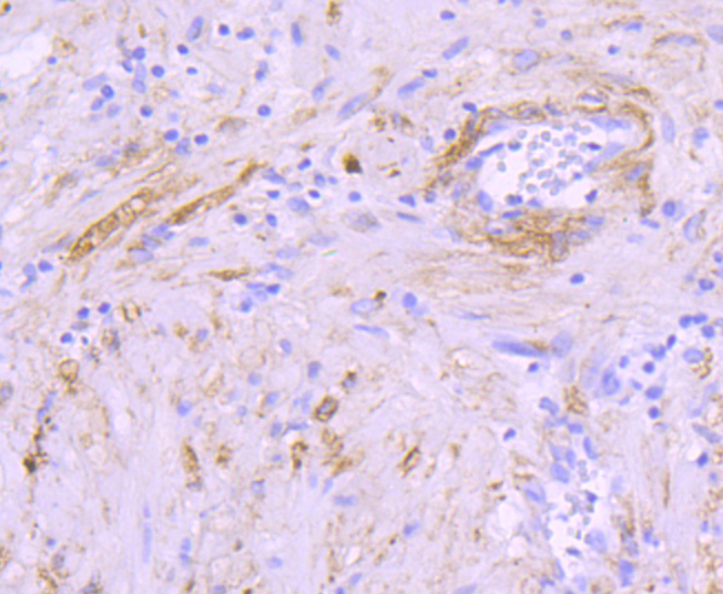 Paraformaldehyde-fixed and paraffin-embedded Human Prostate tissue incubated with Alpha B Crystallin (1B12) Monoclonal Antibody (bsm-54032R) at 1:100, overnight at 4°C, followed by a conjugated secondary antibody and DAB staining. Counterstained with hematoxylin.