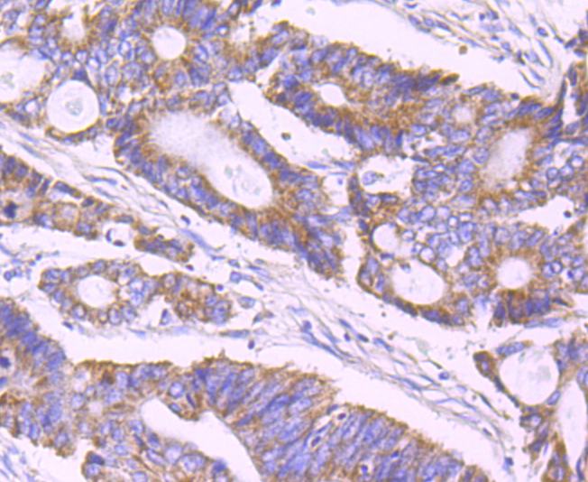 Paraformaldehyde-fixed and paraffin-embedded Human Colon Cancer tissue incubated with ULK1 (2F3) Monoclonal Antibody (bsm-54034R) at 1:100, overnight at 4°C, followed by a conjugated secondary antibody and DAB staining. Counterstained with hematoxylin.