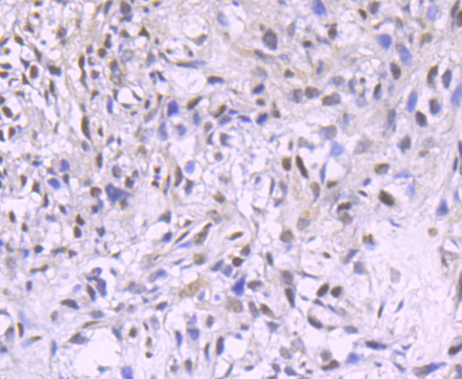 Paraformaldehyde-fixed and paraffin-embedded Human Breast Cancer tissue incubated with PDCD4 (3G1) Monoclonal Antibody (bsm-54041R) at 1:100, overnight at 4°C, followed by a conjugated secondary antibody and DAB staining. Counterstained with hematoxylin.