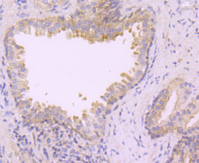 Paraformaldehyde-fixed and paraffin-embedded Human Prostate tissue incubated with MAP3K7 (11A1) Monoclonal Antibody (bsm-54071R) at 1:100, overnight at 4°C, followed by a conjugated secondary antibody and DAB staining. Counterstained with hematoxylin.