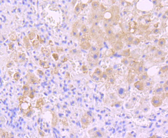 Paraformaldehyde-fixed and paraffin-embedded Human Liver Cancer tissue incubated with Insulin Receptor R (8A1) Monoclonal Antibody (bsm-54080R) at 1:100, overnight at 4°C, followed by a conjugated secondary antibody and DAB staining. Counterstained with hematoxylin.