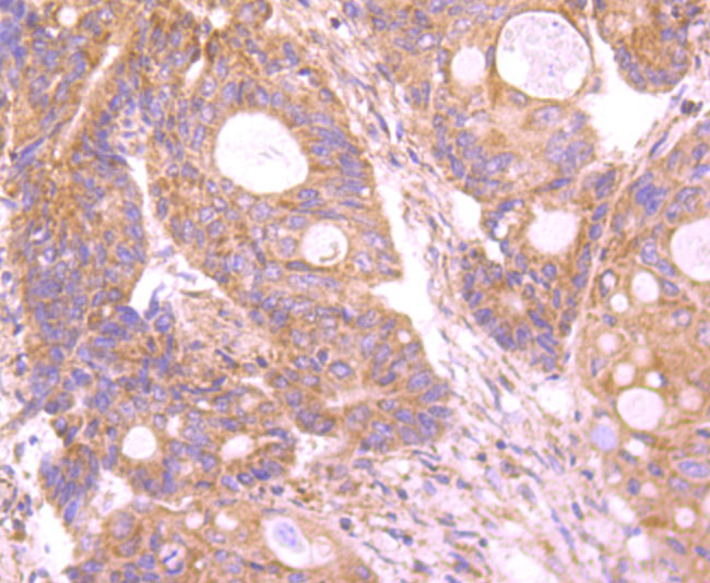 Paraformaldehyde-fixed and paraffin-embedded Human Colon Cancer tissue incubated with Insulin Receptor R (8A1) Monoclonal Antibody (bsm-54080R) at 1:100, overnight at 4°C, followed by a conjugated secondary antibody and DAB staining. Counterstained with hematoxylin.