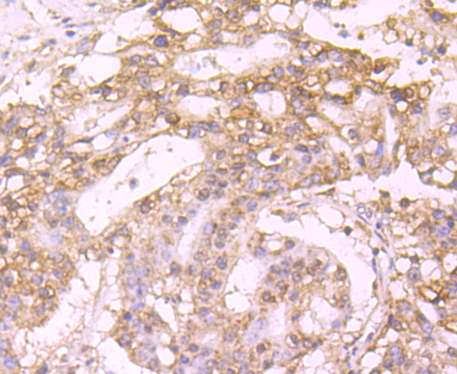 Paraformaldehyde-fixed and paraffin-embedded Human Stomach Cancer tissue incubated with Protein C (4G10) Monoclonal Antibody (bsm-54086R) at 1:100, overnight at 4°C, followed by a conjugated secondary antibody and DAB staining. Counterstained with hematoxylin.