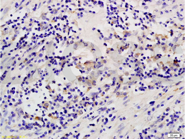 Formalin-fixed and paraffin embedded human colon carcinoma labeled with Anti-MAP3K8/TPL2 Polyclonal Antibody, Unconjugated (bs-3591R) at 1:200 followed by conjugation to the secondary antibody and DAB staining.