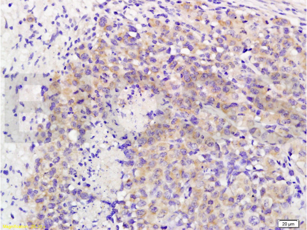 Formalin-fixed and paraffin embedded mouse lymphoma labeled with Rabbit Anti MAP3K8/TPL2 Polyclonal Antibody, Unconjugated (bs-3591R) at 1:200 followed by conjugation to the secondary antibody and DAB staining