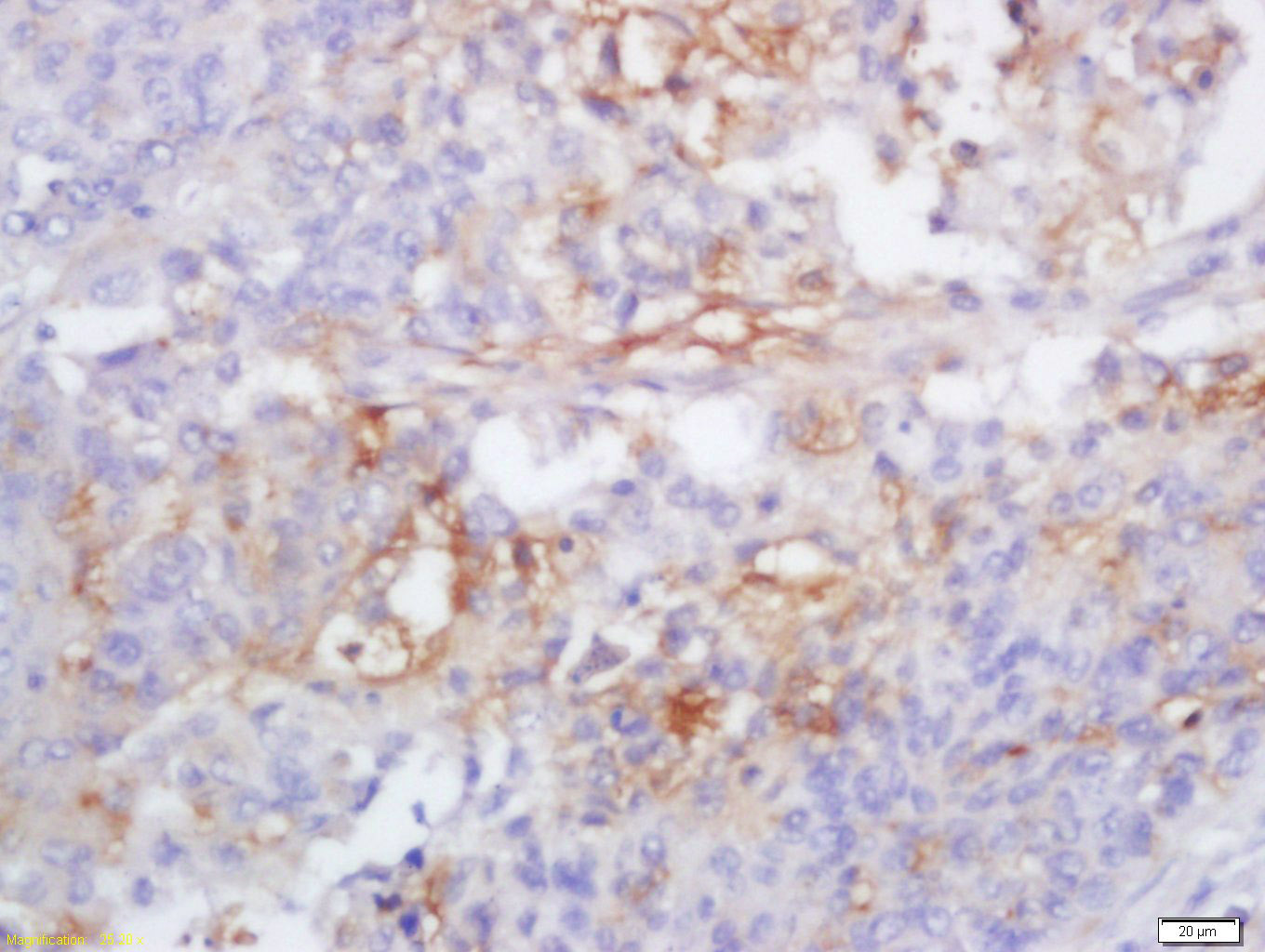 Paraformaldehyde-fixed, paraffin-embedded Human Lung Carcinoma tissue; Antigen retrieval by boiling in sodium citrate buffer (0.01M, pH6) for 15 minutes; Block endogenous peroxidase by 3% hydrogen peroxide for 30 minutes; Blocking buffer (normal goat serum) at 37°C for 20 minutes; Antibody incubation with Caspase-1 P10 Polyclonal Antibody, Unconjugated (bs-0169R) at 1:200 overnight at 4°C, followed by a conjugated secondary antibody, DAB and counterstaining.