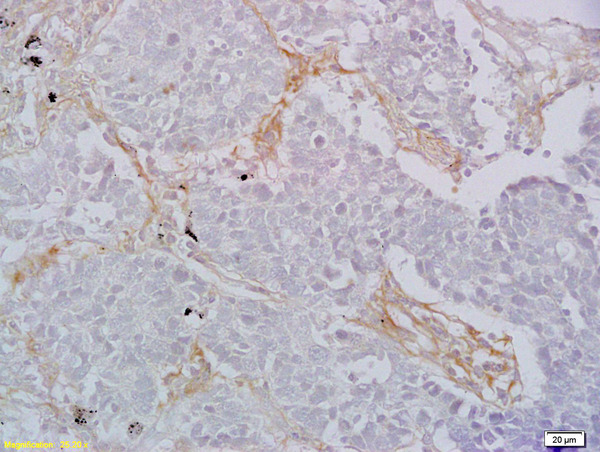 Formalin-fixed and paraffin embedded human lung carcinoma labeled with  Rabbit Anti CD8 Polyclonal Antibody, Unconjugated (bs-4790R) at 1:200 followed by conjugation to the secondary antibody and DAB staining