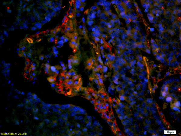 Formalin-fixed and paraffin embedded human lung carcinoma labeled with Anti-CD8 Polyclonal Antibody, Unconjugated (bs-4790R) at 1:200 followed by secondary antibody was Goat Anti-Rabbit IgG, Cy3 conjugated (bs-0295G-Cy3) used at 1:200