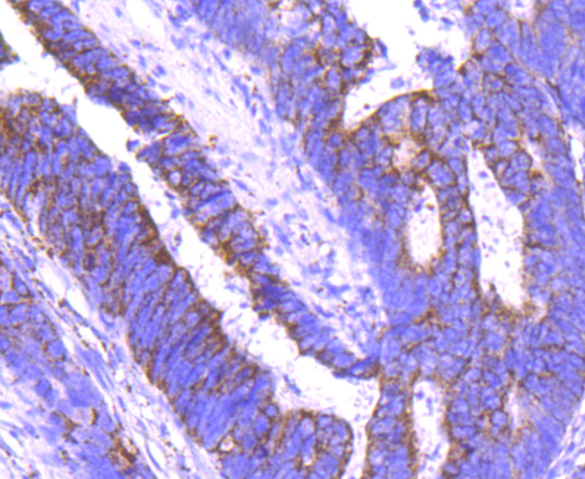 Paraformaldehyde-fixed and paraffin-embedded Human Colon Cancer tissue incubated with Angiopoietin 2 (4G2) Monoclonal Antibody (bsm-54113R) at 1:100, overnight at 4°C, followed by a conjugated secondary antibody and DAB staining. Counterstained with hematoxylin.