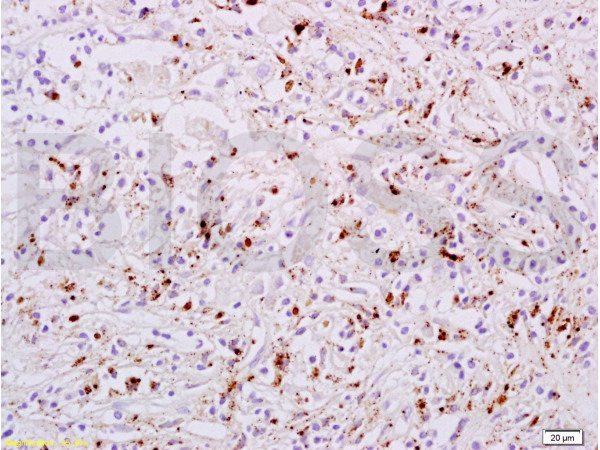 Formalin-fixed and paraffin embedded human liver carcinoma tissue labeled with Anti-phospho-STAT6(Tyr641) Polyclonal Antibody, Unconjugated (bs-1791R) at 1:200 followed by conjugation to the secondary antibody, (SP-0023), and DAB staining