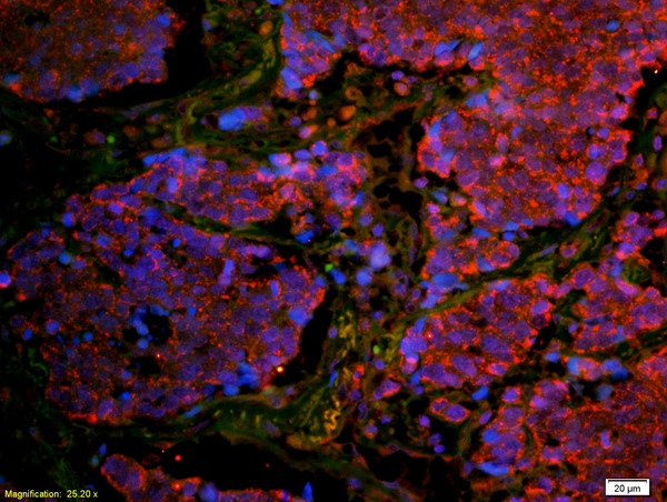 Formalin-fixed and paraffin embedded human lung carcinoma labeled with Anti-CD8B Polyclonal Antibody, Unconjugated (bs-4914R) at 1:200 followed by secondary antibody was Goat Anti-Rabbit IgG, Cy3 conjugated (bs-0295G-Cy3) used at 1:200 dilution for 40 minutes at