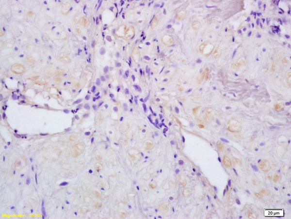 Formalin-fixed and paraffin embedded human stomach labeled with Rabbit Anti ACTRIC/Activin A Receptor Type IC Polyclonal Antibody, Unconjugated (bs-5777R) at 1:200 followed by conjugation to the secondary antibody and DAB staining